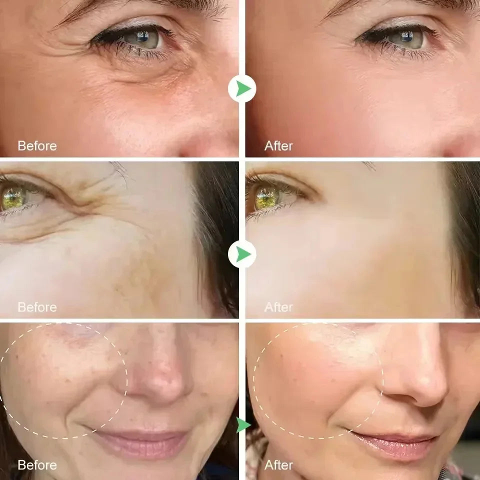 Before and after comparisons of facial skin treatment on a person's face.