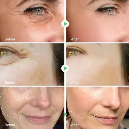 Before and after comparisons of facial skin treatment on a person's face.